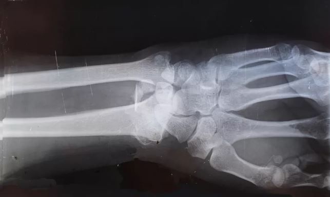 'Apesar de ser mais comum em mulheres, a osteoporose também pode atingir os homens', alerta especialista