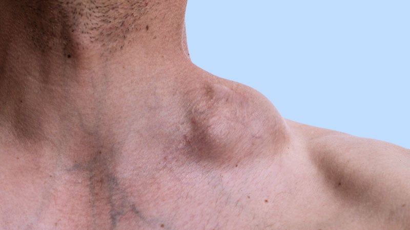 Agosto é o mês de conscientização e combate aos Linfomas, um Câncer que atinge mais de 12 mil brasileiros por ano
