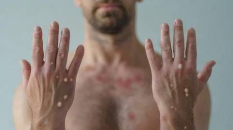 No Acre, município de Cruzeiro do Sul registra caso suspeito de Monkeypox