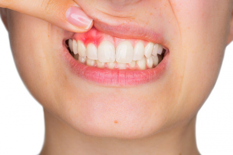 Dentista explica sintomas da doença periodontal que pode levar a perda do dente